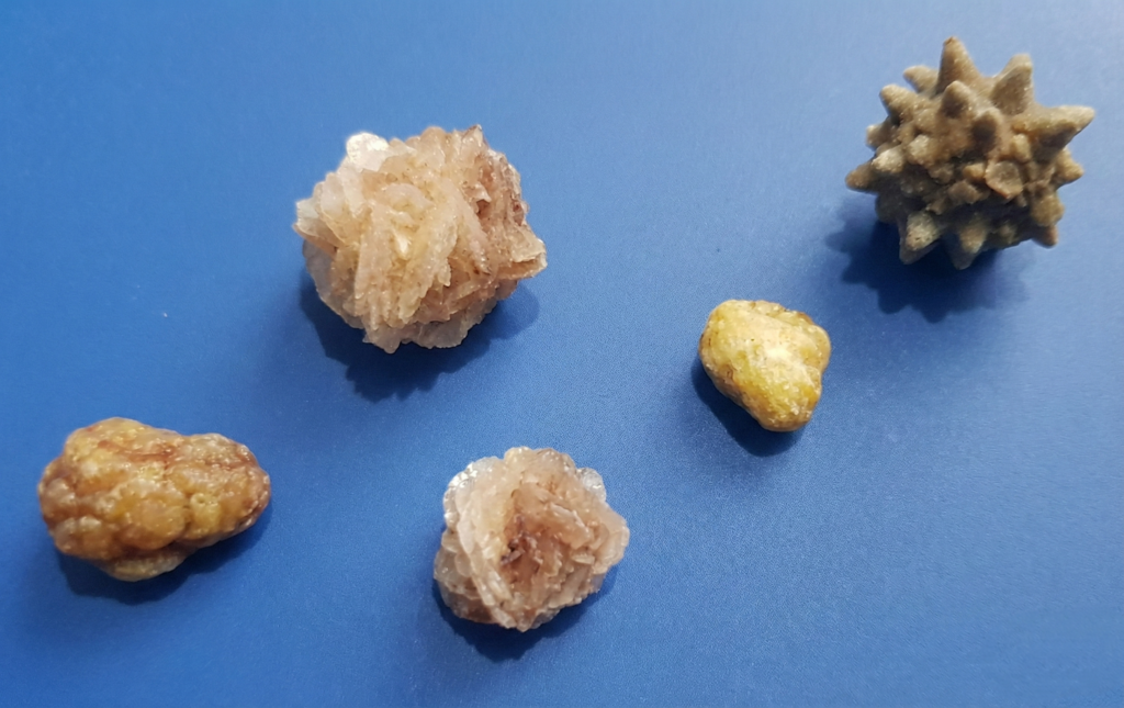 Diferentes tipos de cálculos urinários.